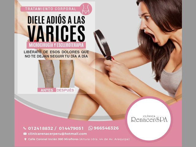 Elimina las varices - Clínica RenacerSpa