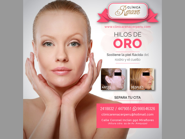 Suspensión facial con hilos - Clínica Renacer