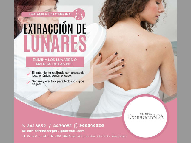 Extracción de lunares difíciles - ClinicaRenacerSpa