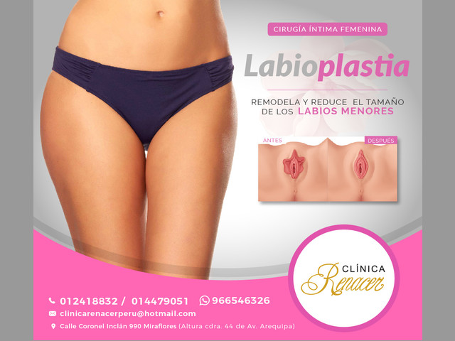 Corrección de labios menores - Clínica Renacer