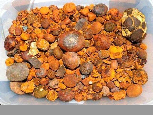 Compramos cálculos biliares (Gallstone)